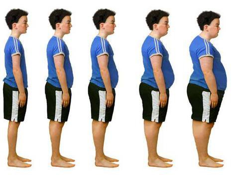 Obesidad, definición y síntomas