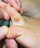 callo en el pie