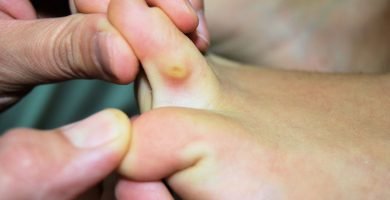 callo en el pie
